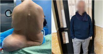 Copertina di Aveva lo stomaco nel gluteo e nella gamba sinistra dopo un incidente, 47enne operato al Monaldi di Napoli