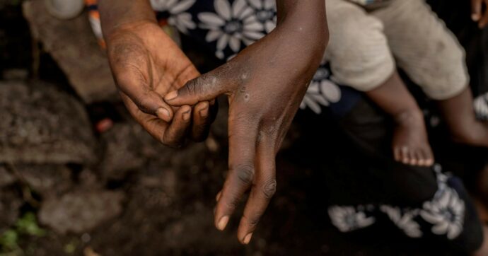 Virus Congo, nell’80% dei casi c’è la malaria