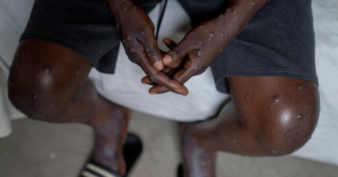 Copertina di Torna dal Congo e muore a Treviso “È malaria grave”