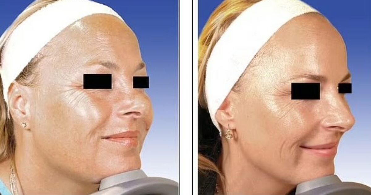 Una delle due gemelle ha usato botox per 20 anni, l’altra no: quali differenze si notano? Lo studio