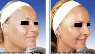 Copertina di Una delle due gemelle ha usato botox per 20 anni, l’altra no: quali differenze si notano? Lo studio