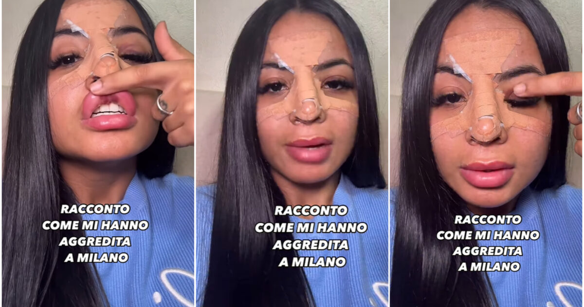 Modella di OnlyFans aggredita a Milano: “Mi hanno sbattuto la testa contro un palo, poi mi hanno dato un calcio. Mi hanno rotto bocca e naso”