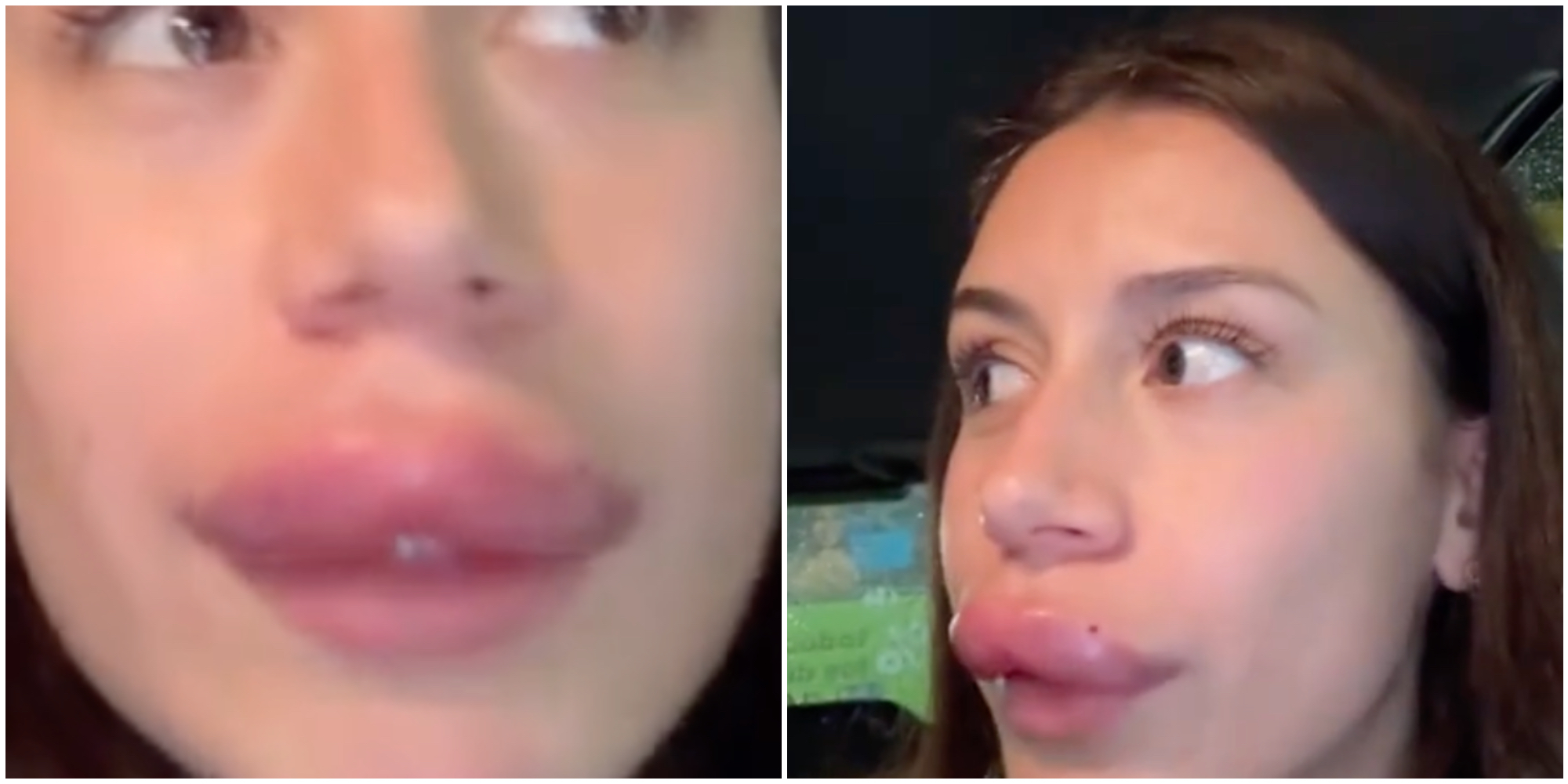 “Ho un labbro enorme! Se avete intenzione di farvi fare un ritocco assicuratevi che sia una clinica decente”: lo sfogo dell’influencer Sandra González