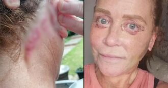 Copertina di “Ho fatto un lifting e ora non riesco più a chiudere gli occhi, neanche per dormire. Sembra un film dell’orrore”. Il calvario di Joanne, sfigurata da un intervento di chirurgia estetica