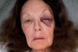 Copertina di “Ho il volto contuso e un occhio nero. All’arrivo a Los Angeles, sono caduta sul marciapiede e ho battuto la fronte!”: la denuncia di Diane von Furstenberg