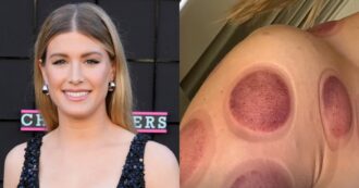 Copertina di “La coppettazione non è uno scherzo”: l’avvertimento di Eugenie Bouchard che mostra gli impressionanti segni della terapia