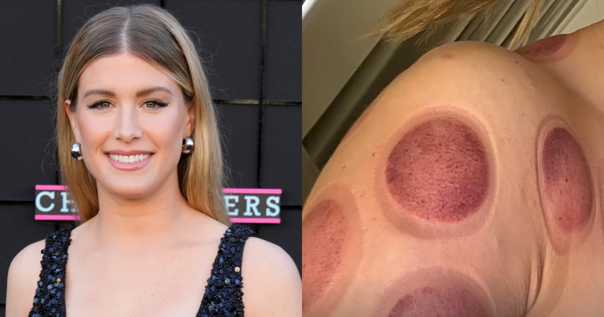 “La coppettazione non è uno scherzo”: l’avvertimento di Eugenie Bouchard che mostra gli impressionanti segni della terapia