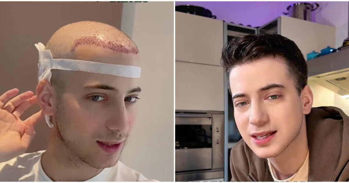 “Ho avuto l’alopecia per il forte stress e ho fatto il trapianto per i capelli. Ho cambiato sei scuole, ero ribelle”: lo rivela Jack di MasterChef Italia