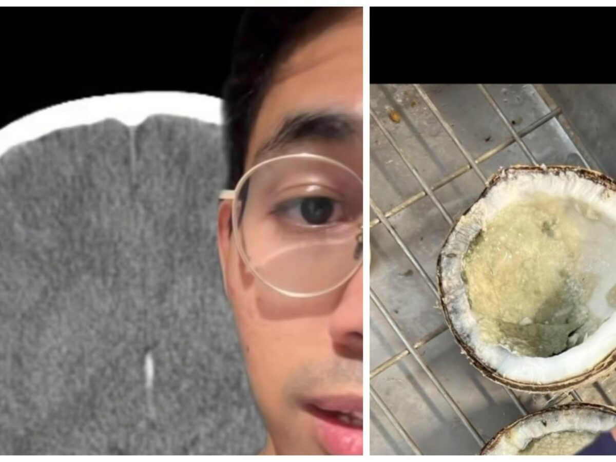 “Beve un sorso d’acqua della noce di cocco andata a male, muore dopo 26 ore di agonia. Era un fungo letale”: il dottor Samuel Choudhury lancia l’allarme