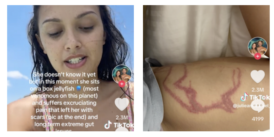 Influencer si fa un video mentre viene punta da uno degli animali più velenosi al mondo, la medusa scatola: “Rischiavo un attacco cardiaco nel giro di mezz’ora”