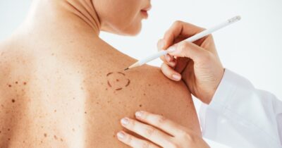 Copertina di “Attenzione a quel neo quando prendete il sole: se prude, cambia colore o sanguina può essere un segnale di melanoma”: il monito della dermatologa