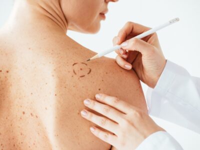 Copertina di “Attenzione quando andate in montagna: altitudine, neve e ghiaccio aumentano il rischio di melanoma”. I consigli dell’esperto per proteggersi dai raggi UV