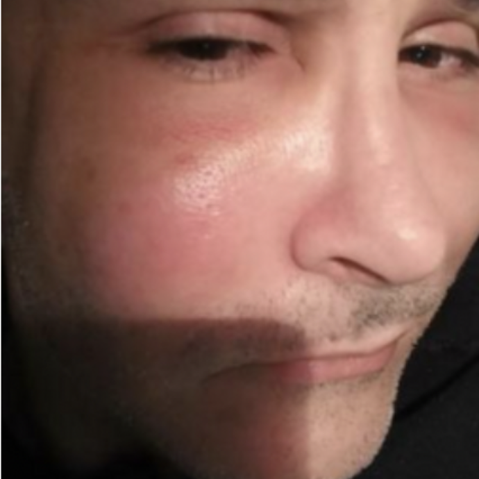 “Volevo trattare le rughe del viso ma mi non so cosa mi abbia iniettato. Ho sofferto di depressione”: parla un uomo deturpato dal ‘dottor silicone’ Stefano Stracciari