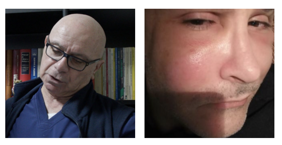 “Volevo trattare le rughe del viso ma mi non so cosa mi abbia iniettato. Ho sofferto di depressione”: parla un uomo deturpato dal ‘dottor silicone’ Stefano Stracciari