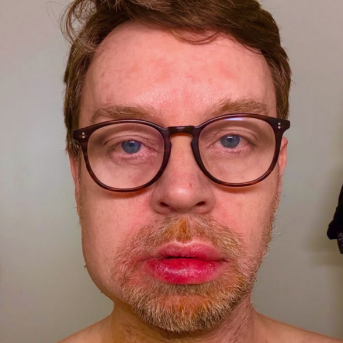 “La mascella si è spezzata a metà, mi sono svegliato in una pozza di sangue”: Darren Hayes dei Savage Garden irriconoscibile dopo l’incidente