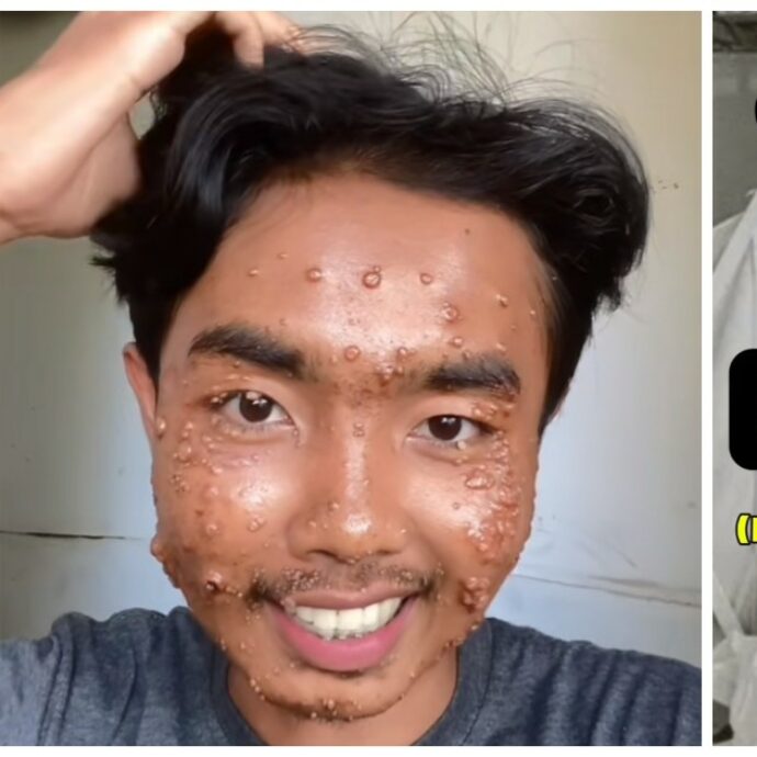 “Ho indossato i vestiti comprati in un negozio dell’usato, ma senza lavarli. Ora ho un’infezione della pelle”: l’avvertimento del tiktoker