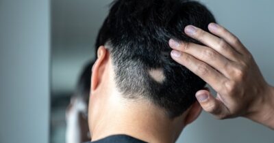 Copertina di Arriva il primo farmaco per la ricrescita dei capelli, adatto per adulti e adolescenti: “L’alopecia areata colpisce tra i 10 e i 25 anni, ha un peso emotivo e psicologico”