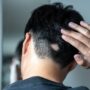 Copertina di Arriva il primo farmaco per la ricrescita dei capelli: “L’alopecia areata colpisce tra i 10 e i 25 anni, ha impatto psicologico”