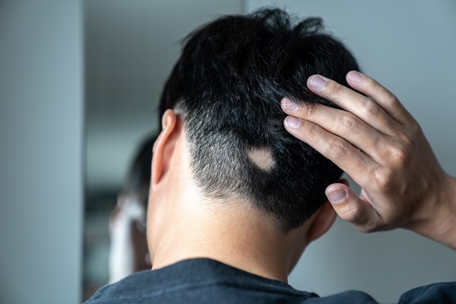 Arriva il primo farmaco per la ricrescita dei capelli, adatto per adulti e adolescenti: “L’alopecia areata colpisce tra i 10 e i 25 anni, ha un peso emotivo e psicologico”