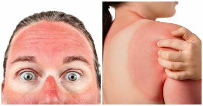 Copertina di “Bastano 5 scottature solari tra i 15 e i 20 anni d’età per aumentare dell’80% il rischio di melanoma”: l’allarme nel nuovo studio