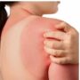 Copertina di “Bastano 5 scottature solari tra i 15 e i 20 anni d’età per aumentare dell’80% il rischio di melanoma”: l’allarme nel nuovo studio