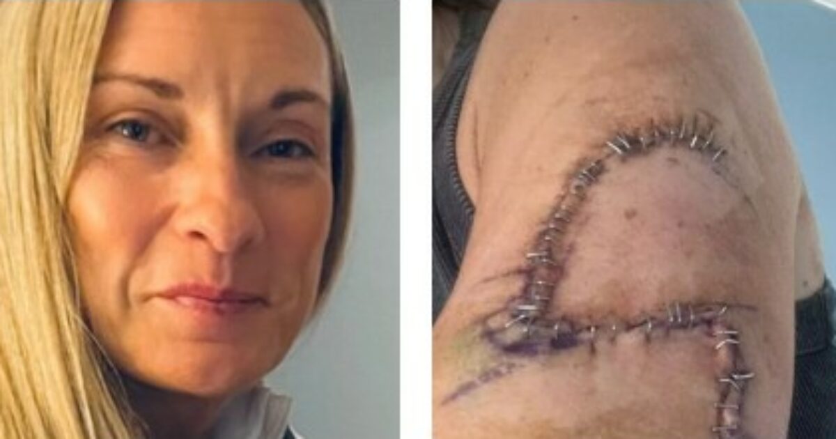 “Avevo un neo sul braccio che mi sembrava normalissimo ma quando l’ho tolto la diagnosi è stata tremenda, ora ho 77 punti e una nuova consapevolezza”: la storia di Jane Murray “Avevo un neo sul braccio che mi sembrava normalissimo ma quando l’ho tolto la diagnosi è stata tremenda, ora ho 77 punti e una nuova consapevolezza”: la storia di Jane Murray