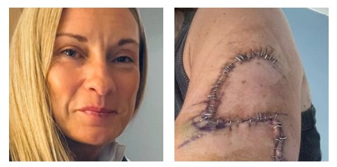 “Avevo un neo sul braccio che mi sembrava normalissimo ma quando l’ho tolto la diagnosi è stata tremenda, ora ho 77 punti e una nuova consapevolezza”: la storia di Jane Murray