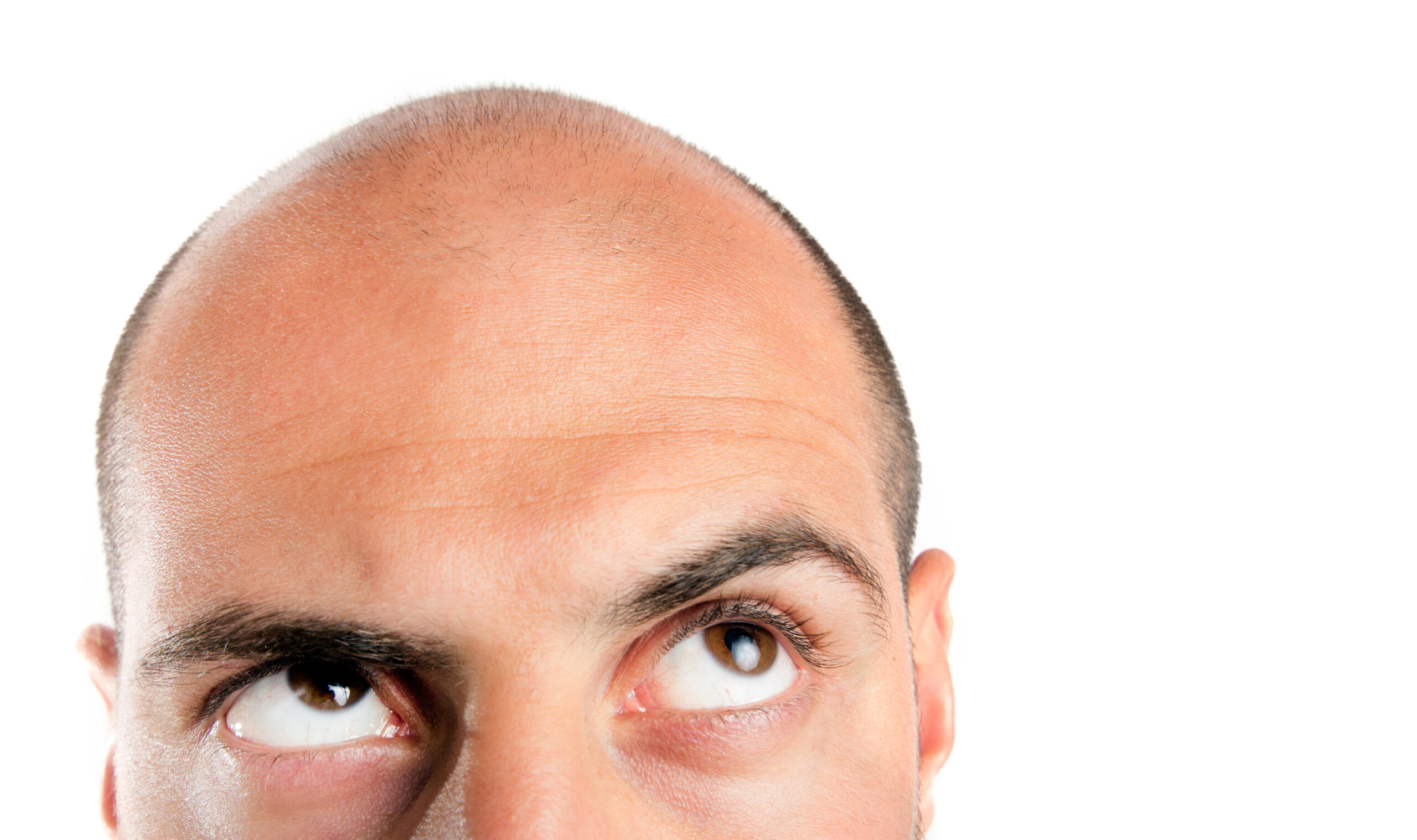 il farmaco finasteride utilizzato per la calvizie può causare pensieri suicidi l allarme dell agenzia europea del farmaco e il parere dell esperto da Ilfattoquotidiano.it il farmaco finasteride utilizzato per la calvizie può causare pensieri suicidi l allarme dell agenzia europea del farmaco e il parere dell esperto