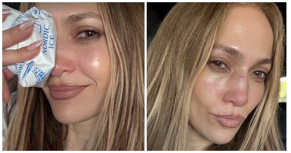 “Grazie per avermi ricucita”: ha un incidente e si ferisce al naso, Jennifer Lopez corre dal chirurgo plastico