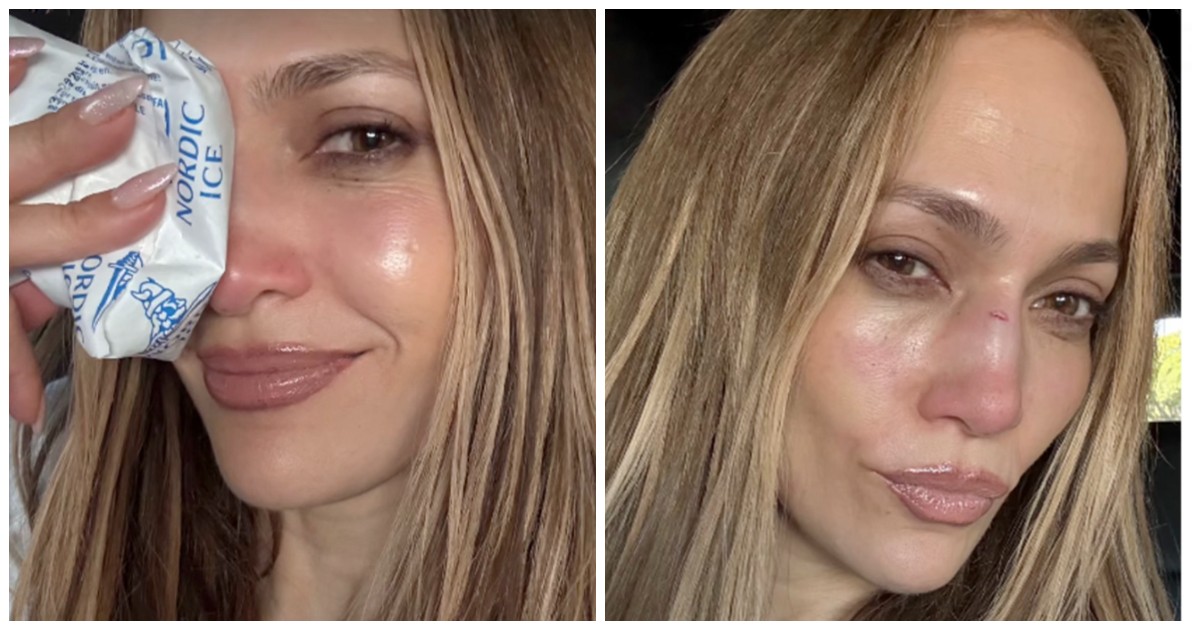 grazie per avermi ricucita ha un incidente e si ferisce al naso jennifer lopez corre dal chirurgo plastico da Ilfattoquotidiano.it grazie per avermi ricucita ha un incidente e si ferisce al naso jennifer lopez corre dal chirurgo plastico