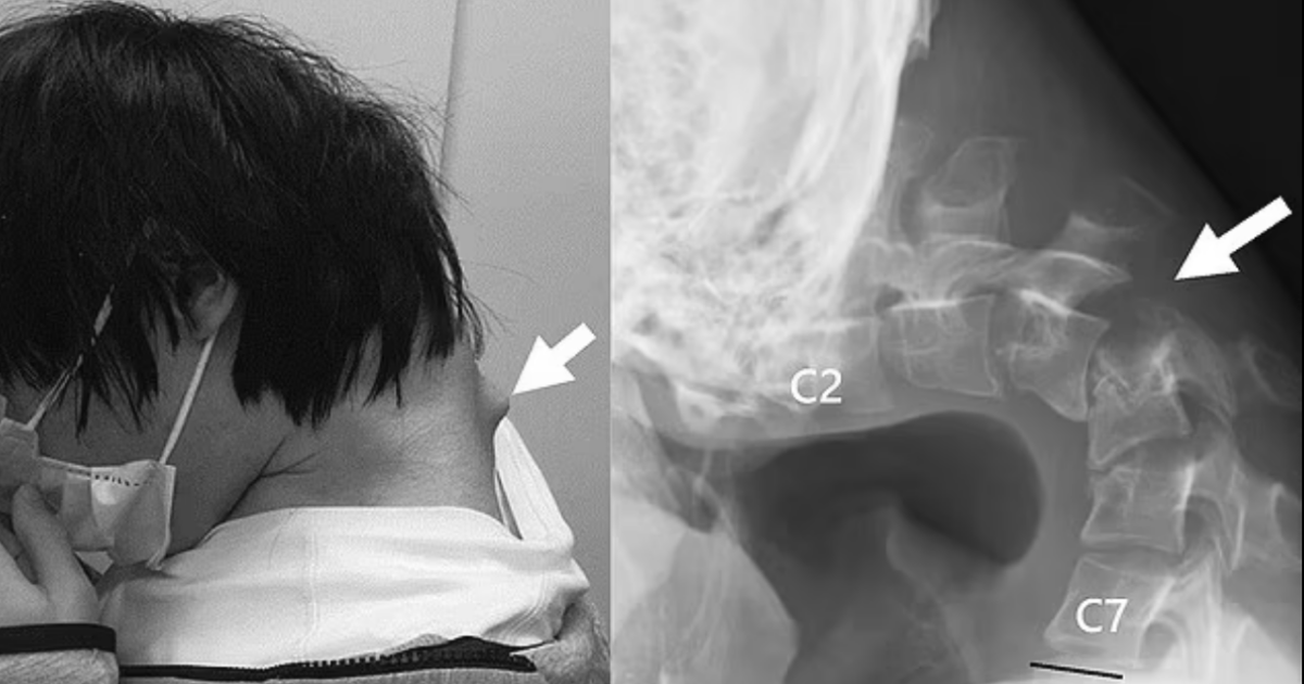 25enne passa ore e ore a giocare sul cellulare e sviluppa la ‘sindrome della testa bassa’. L’allarme dei medici: “Fenomeno in aumento, attenzione”