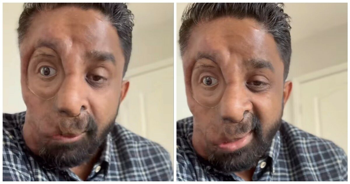 “Ho la neurofibromatosi di tipo 1. Non mi hanno servito al bar per il mio viso. Tutti mi fissavano come se avessero visto un fantasma”: lo sfogo di Amit Ghose