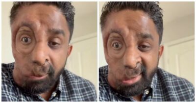 Copertina di “Ho la neurofibromatosi di tipo 1. Non mi hanno servito al bar per il mio viso. Tutti mi fissavano come se avessero visto un fantasma”: lo sfogo di Amit Ghose