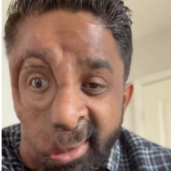 “Ho la neurofibromatosi di tipo 1. Non mi hanno servito al bar per il mio viso. Tutti mi fissavano come se avessero visto un fantasma”: lo sfogo di Amit Ghose