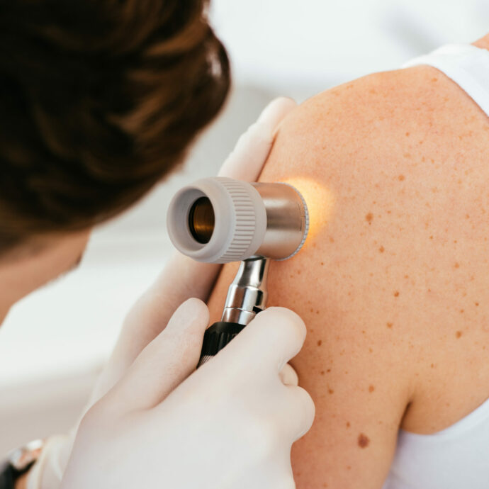 “Bisogna sempre evitare le scottature, quando mettete la crema solare non dimenticatevi di questi punti”: i consigli della dermatologa nella Giornata europea per la prevenzione del melanoma