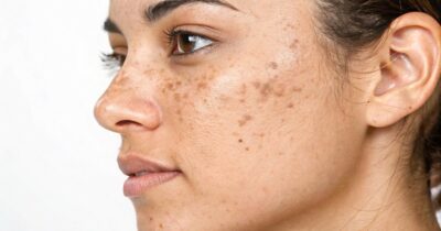 Copertina di Come prevenire le macchie solari? I consigli della dermatologa: “La pelle ha una memoria, ogni scottatura lascia un’impronta”