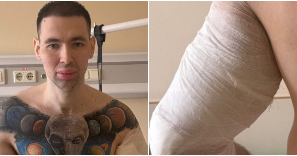 Si inietta l’olio nei bicipiti per renderli più grossi e viene ricoverato d’urgenza in ospedale: l’incidente del “Braccio di Ferro” russo Kirill Tereshin
