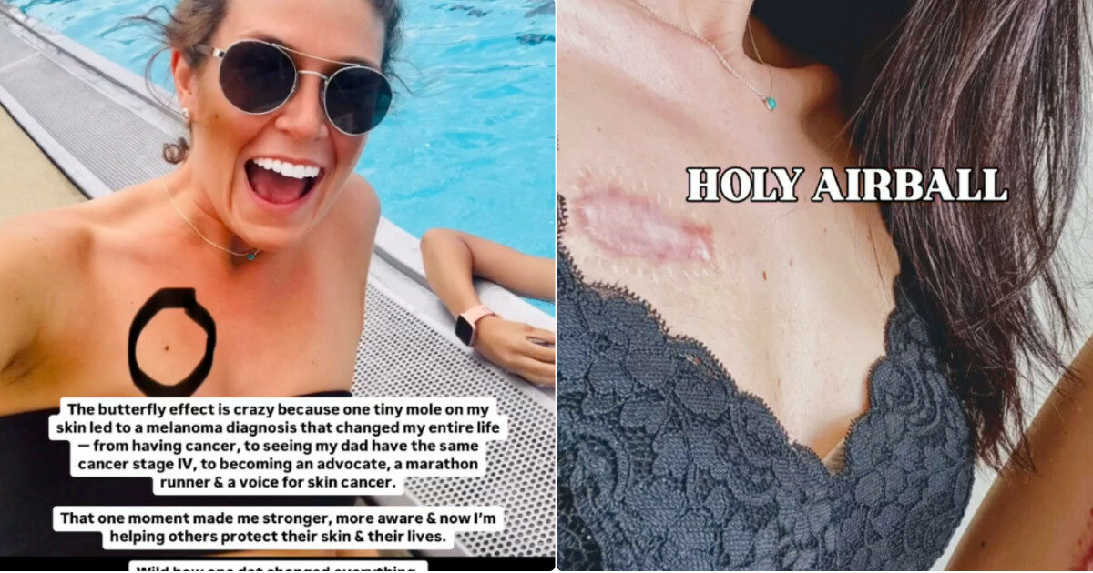 “Pensavo fosse un neo, ma era un cancro che mi ha rovinato la vita. Ho 30 anni e cicatrici su tutto il corpo”: la storia di Leah Alexis Adams