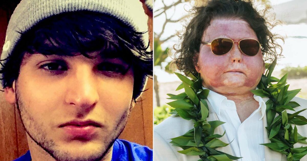 “Ho perso l’80% della mia pelle, ho la faccia e le mani di qualcun altro. In 3 mesi di coma ho visto ...