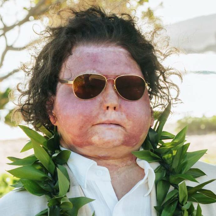 “Ho perso l’80% della mia pelle, ho la faccia e le mani di qualcun altro. In 3 mesi di coma ho visto l’aldilà: portavo a spasso il mio cane all’infinito”: il racconto di Joe Di Meo