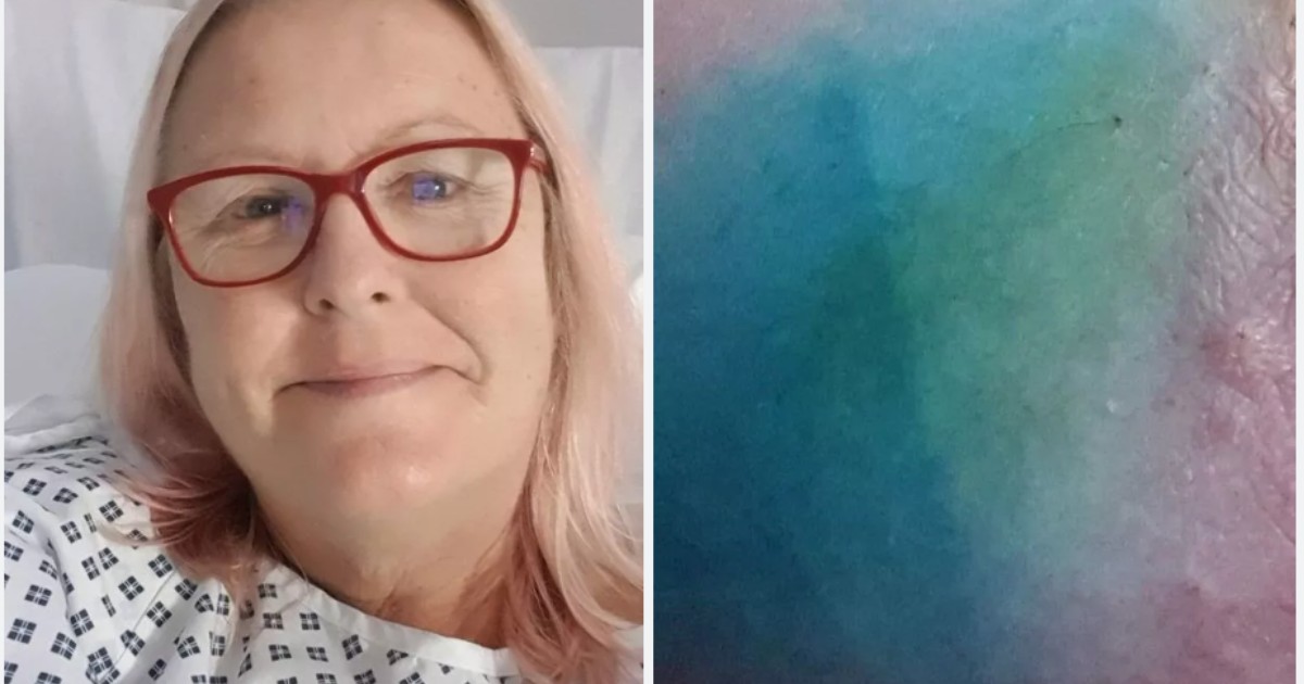 “Mi sono svegliata e il mio seno era blu. Nessuno te lo dice”. La storia della battaglia contro il cancro di Beverley Godsell, soprannominata dagli amici “Puffetta” “Mi sono svegliata e il mio seno era blu. Nessuno te lo dice”. La storia della battaglia contro il cancro di Beverley Godsell, soprannominata dagli amici “Puffetta”