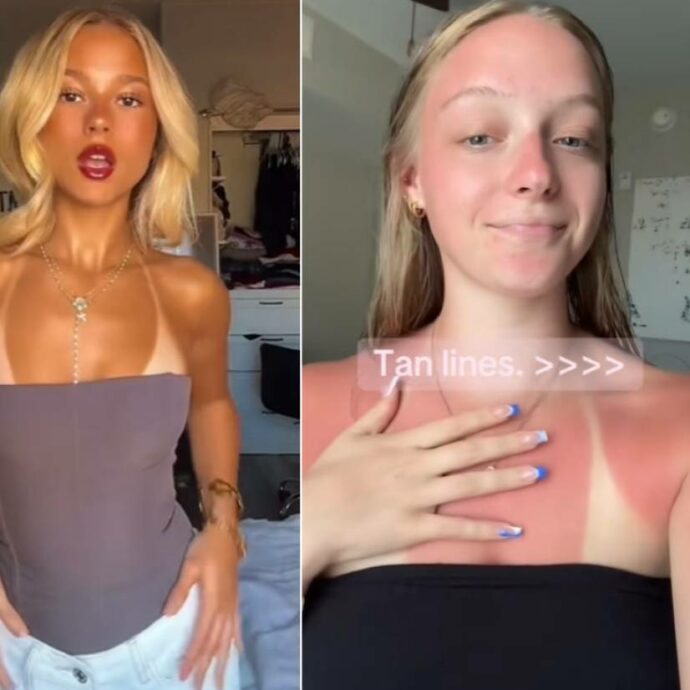 Su TikTok spopola l’”abbronzatura selvaggia” con la gara a mostrare le scottature solari, l’esperto avverte: “È una moda pericolosissima, si rischia il cancro”