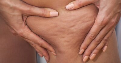 Copertina di Gambe pesanti con il caldo? I consigli degli esperti, i massaggi e i prodotti anti-cellulite per coccolare il corpo in estate