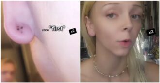 Copertina di “I ragni portano rancore”: morsa da un ragno violino dopo aver provato a ucciderlo, 26enne mostra il “buco dell’orrore” che le ha lasciato sull’orecchio