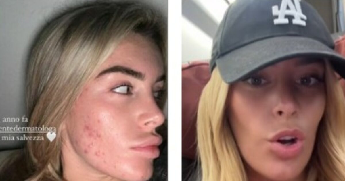 “L’acne non ci rende meno degne di essere guardate con amore. Un anno fa ero intrappolata in quella sensazione costante di disagio”: così Sophie Codegoni