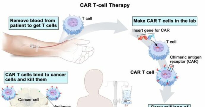 L’immunoterapia anti tumorale Car-T: una promessa per i pazienti, una sfida per il servizio sanitario
