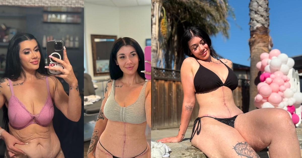 le mie cicatrici dell8217addominoplastica paragonate a quelle di frankestein il corpo non deve essere giudicato dalla societ224 natalia aranda si sfoga