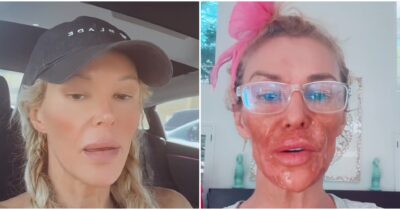 Copertina di “Ho usato la crema depilatoria per un parassita e mi sono ustionata. Ho esagerato io”: Brandi Glanville si mostra su TikTok. Ma c’è chi le dice: “Eccessivo filler”