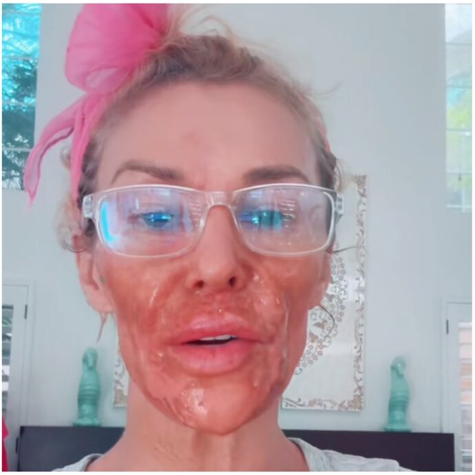 “Ho usato la crema depilatoria per un parassita e mi sono ustionata. Ho esagerato io”: Brandi Glanville si mostra su TikTok. Ma c’è chi le dice: “Eccessivo filler”
