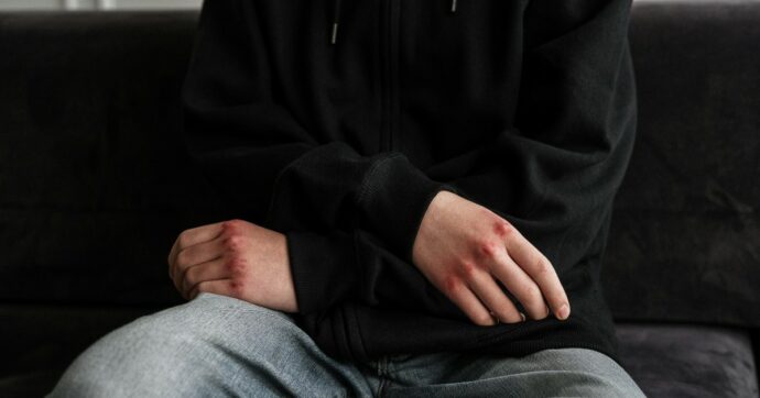 Perugia, il patrigno litiga con la madre: 17enne lo colpisce con una spranga. Accusato di tentato omicidio